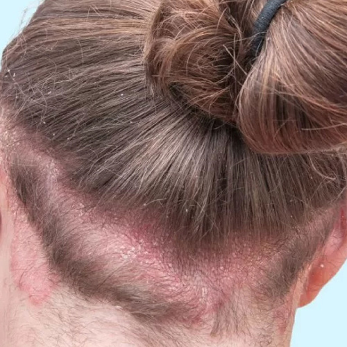 Ragazzo con capelli biondi raccolti che mostra la psoriasi del cuoio capelluto che ha nel retro della testa