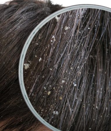 Foto di una lente d'ingrandimento che mostra la forfora nei capelli