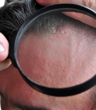 psoriasi del cuoio capelluto sulla fronte, indice di sistema immunitario molto debole